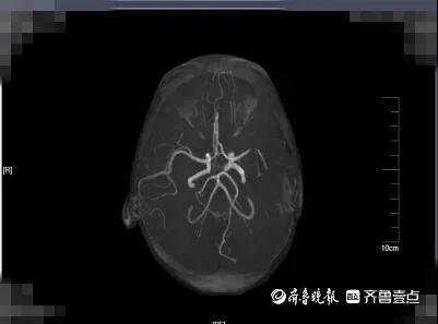 红斑狼疮到底是什么病