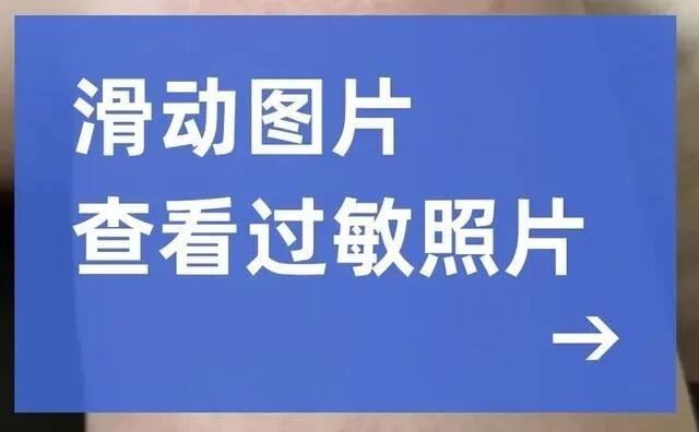 过敏是因为免疫力太强了